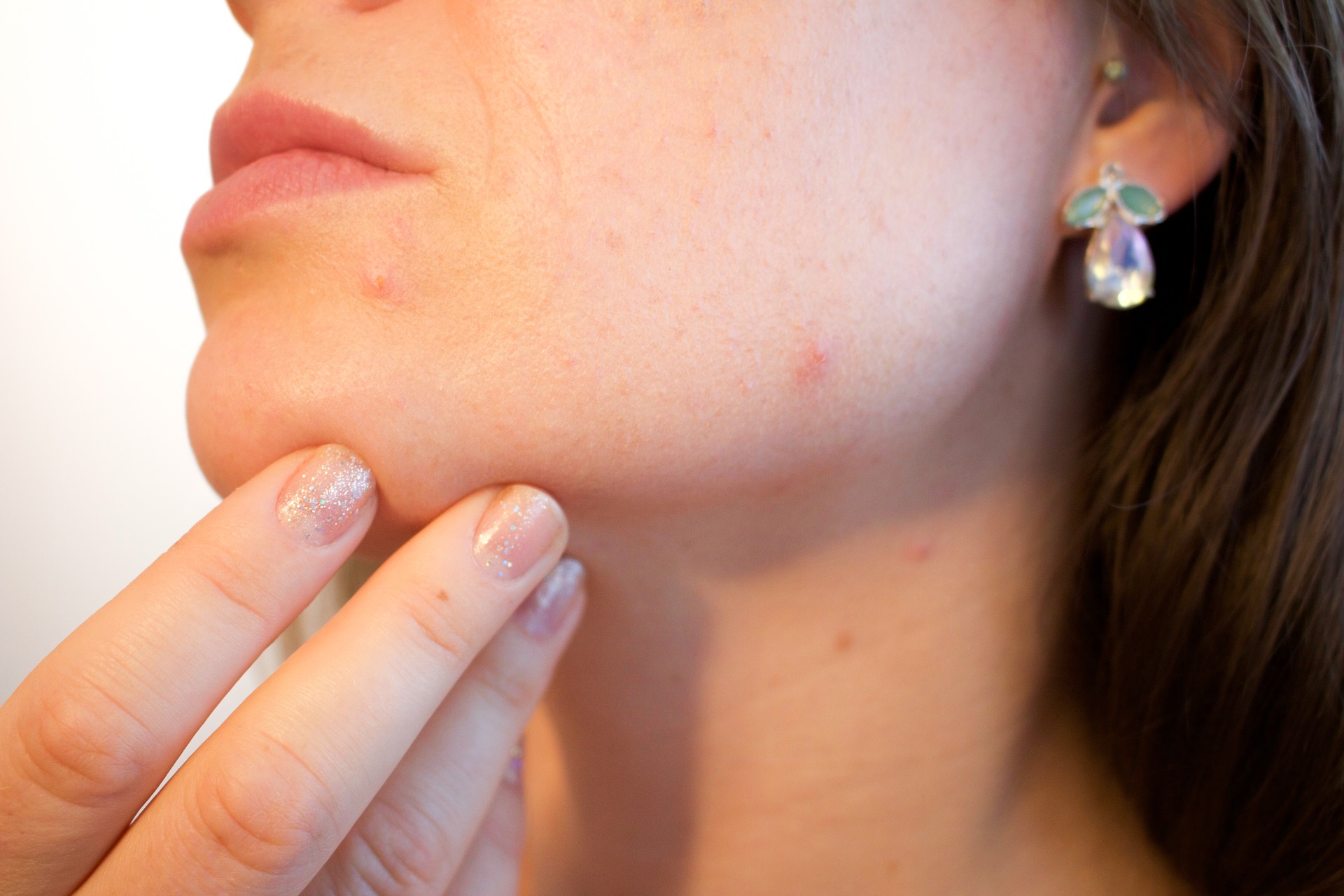 Best Acne Scar Remedies Image